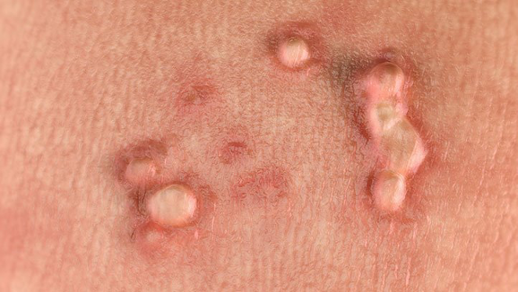 Non-Cancerous warts caused by low-risk HPB