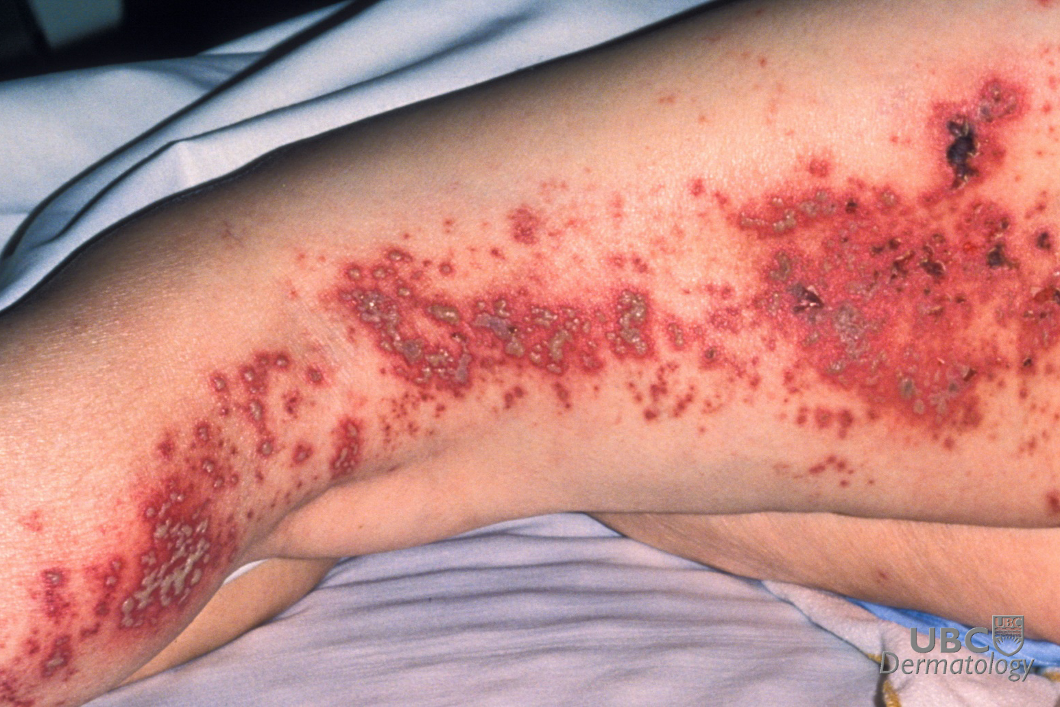 Shingles herpes zoster HL