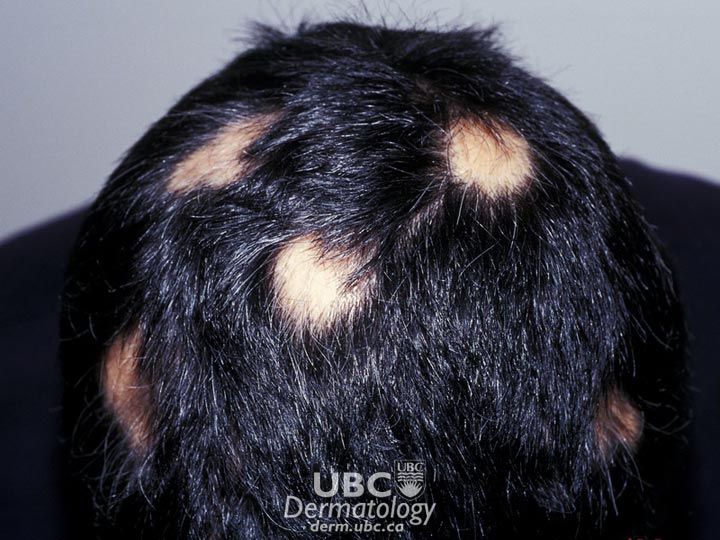 hair disorders-2 alopecia areata