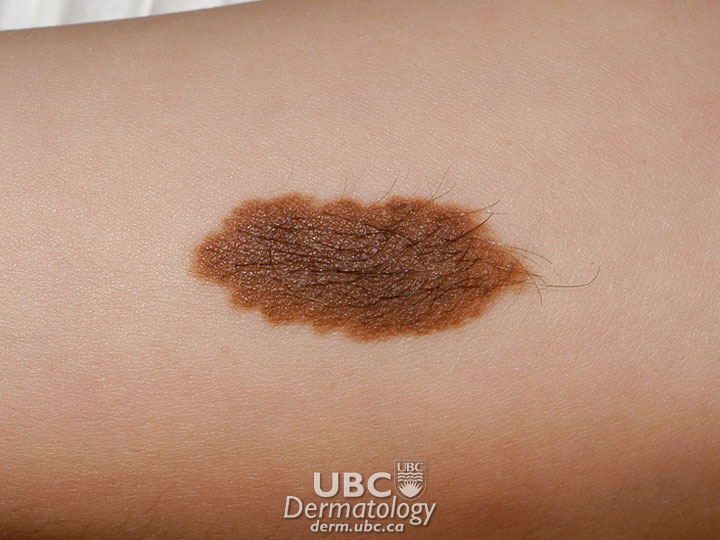 birthmark-2 congenital mole