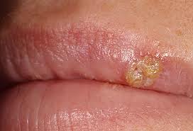 cold sore 1