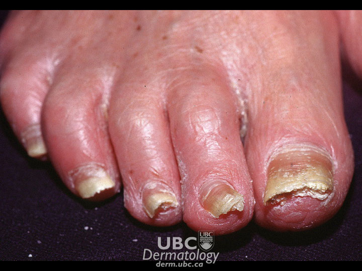 Nail Fungus: Causes, Symptoms, Treatments, And Prevention