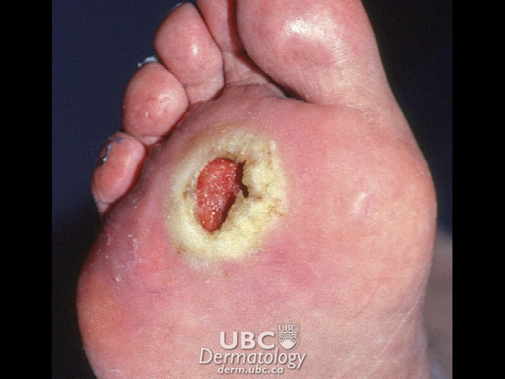 skin ulcer 1