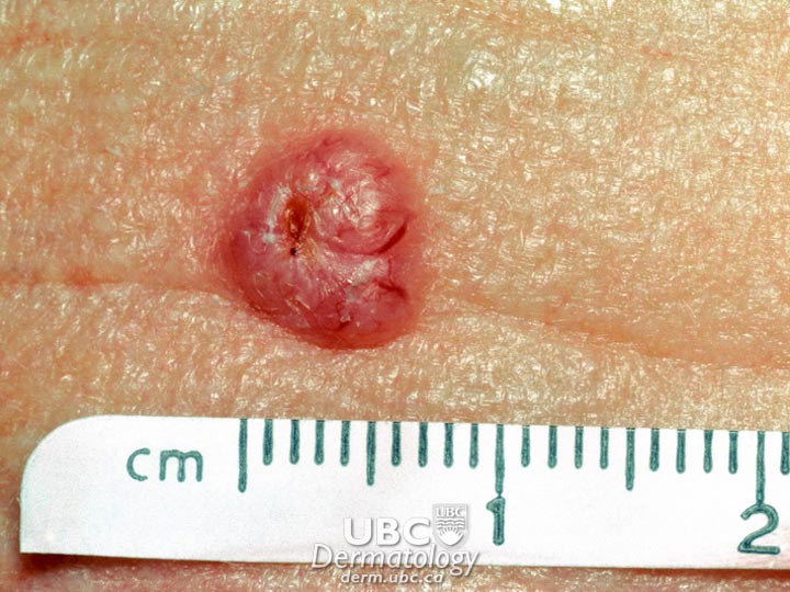 skincancer2-BasalCellCarcinoma